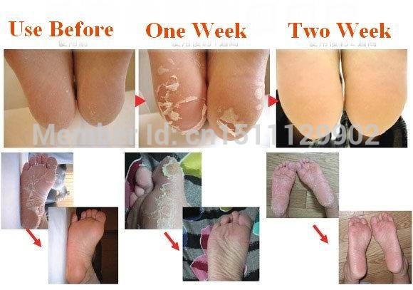5pair10pcs-Baby-Feet-Skin-Smooth-Exfoliating-Foot-Mask-Foot-Care-Mask-Foot-Care-Health-Care-Pedicure-1887256683
