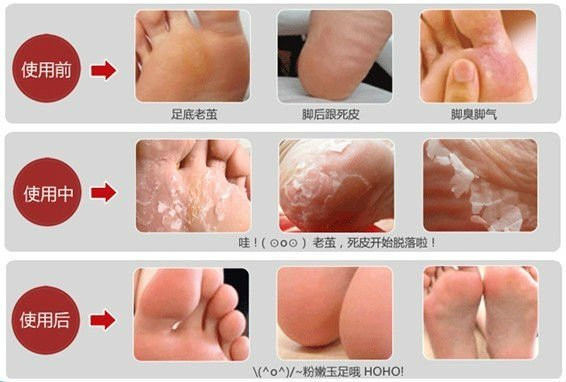5pair10pcs-Baby-Feet-Skin-Smooth-Exfoliating-Foot-Mask-Foot-Care-Mask-Foot-Care-Health-Care-Pedicure-1887256683