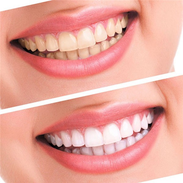 Popular-White-Teeth-Whitening-Pen-Tooth-Gel-Whitener-Bleach-Remove-Stains-Oral-Hygiene-32712575166